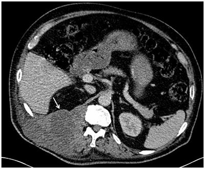 Case report: Uncommon presentation of Salmonella Dublin infection as a large paravertebral abscess